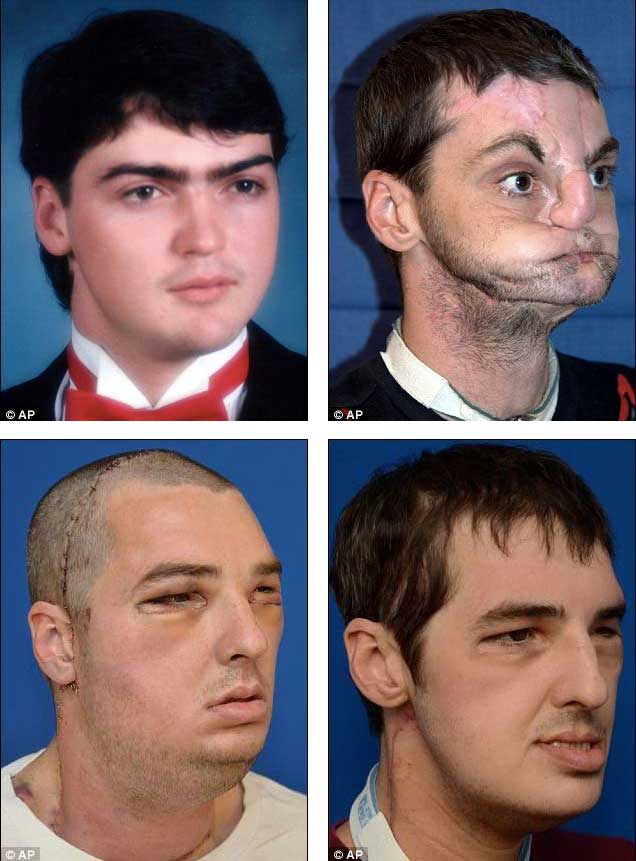 Face-Transplant transplante-de-cara Cultura-Inquieta