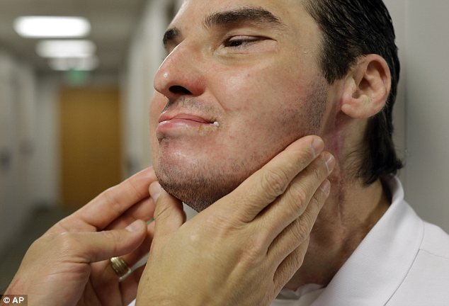 Face-Transplant transplante-de-cara Cultura-Inquieta2