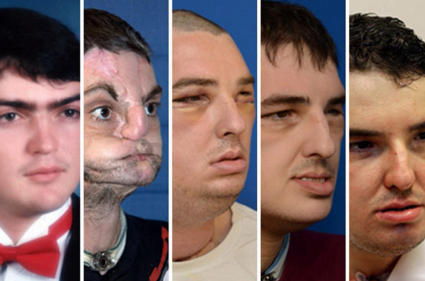 Face Transplant transplante de cara