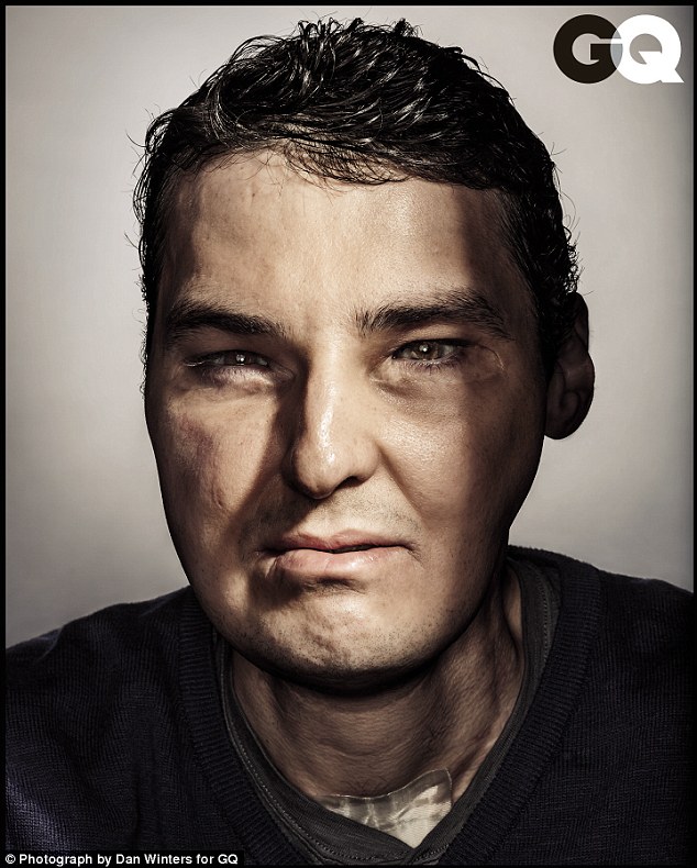 Face Transplant transplante de cara1