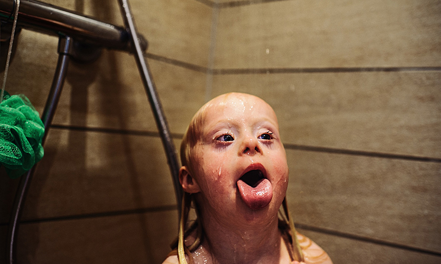 Sindrome de Down Down Syndrome Mario Wezel