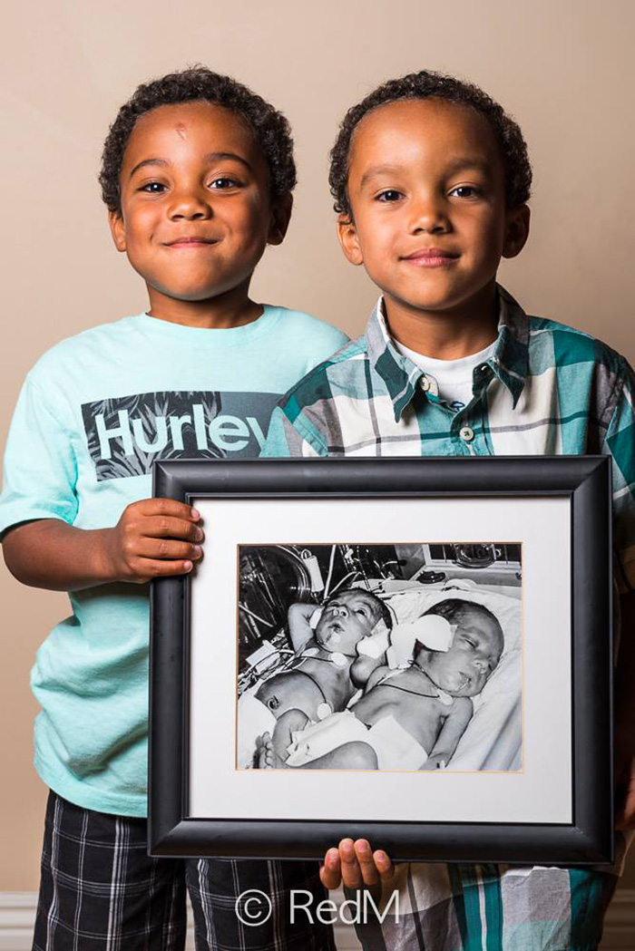 Premature Babies bebe prematuro3
