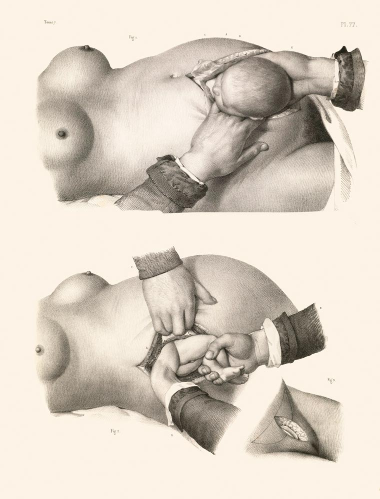 Disturbing Vintage Medical Illustrations Richard-Barnett 11