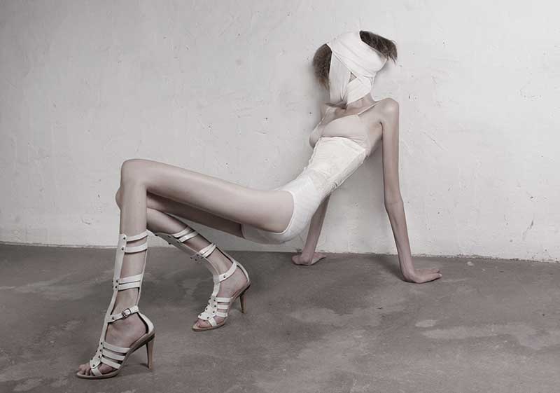 32-KILOS Ivonne-Thein anorexia