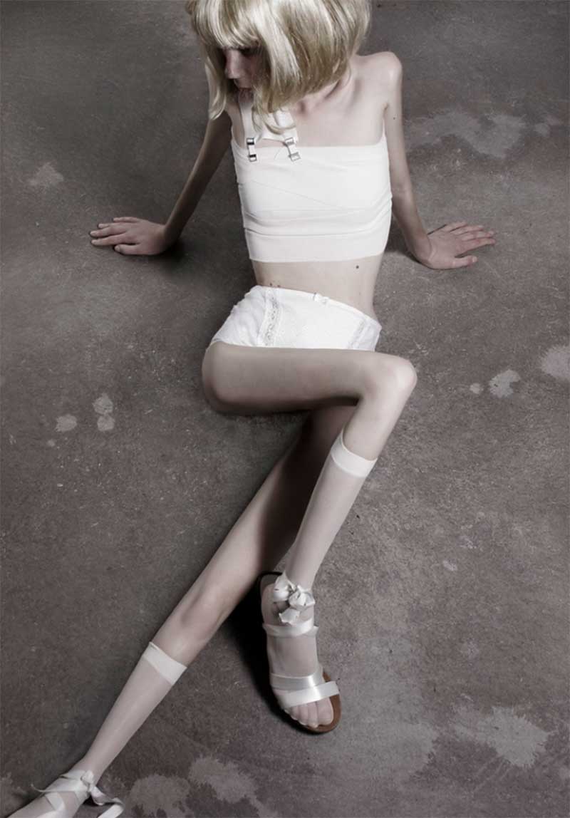32-KILOS Ivonne-Thein anorexia9