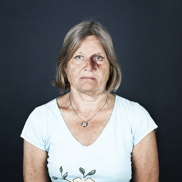 Linda Hasen marcas de nacimiento 11