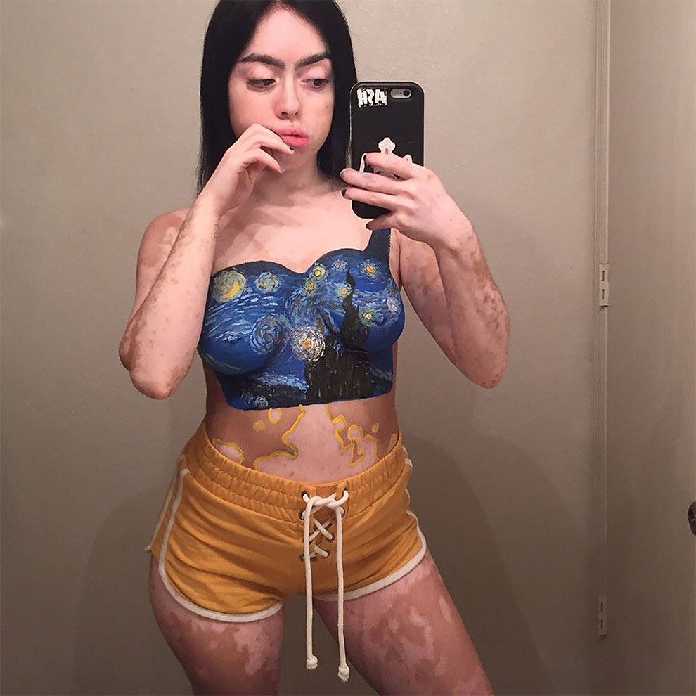 Vitiligo Ash Soto 10