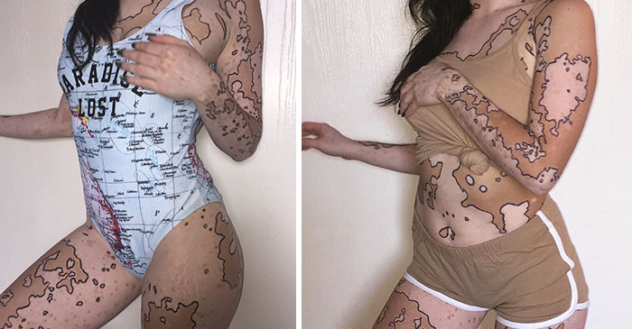 Vitiligo Ash Soto 15
