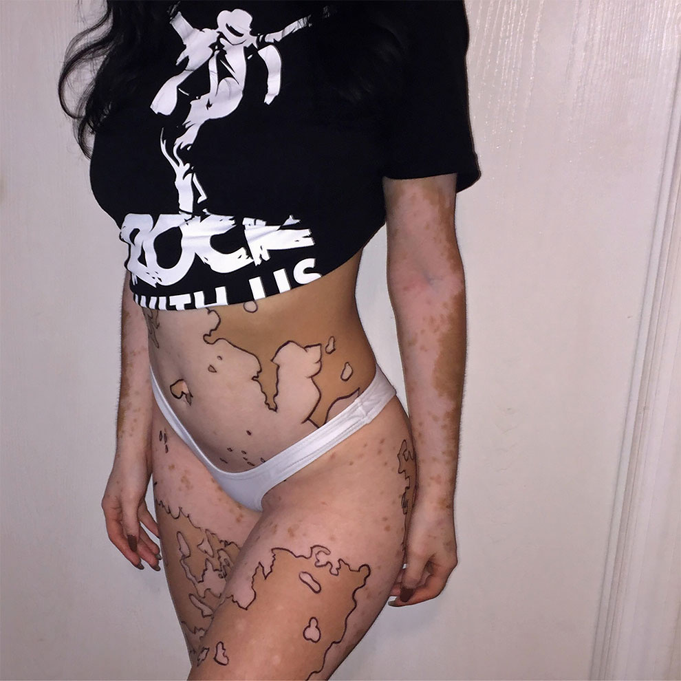 Vitiligo Ash Soto 5