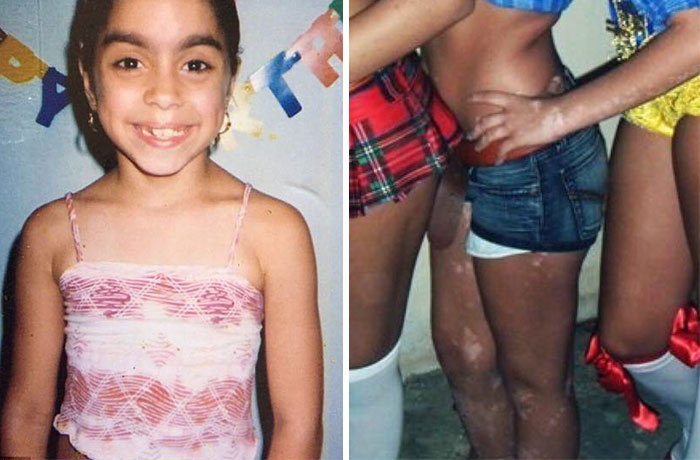 Vitiligo Ash Soto 7