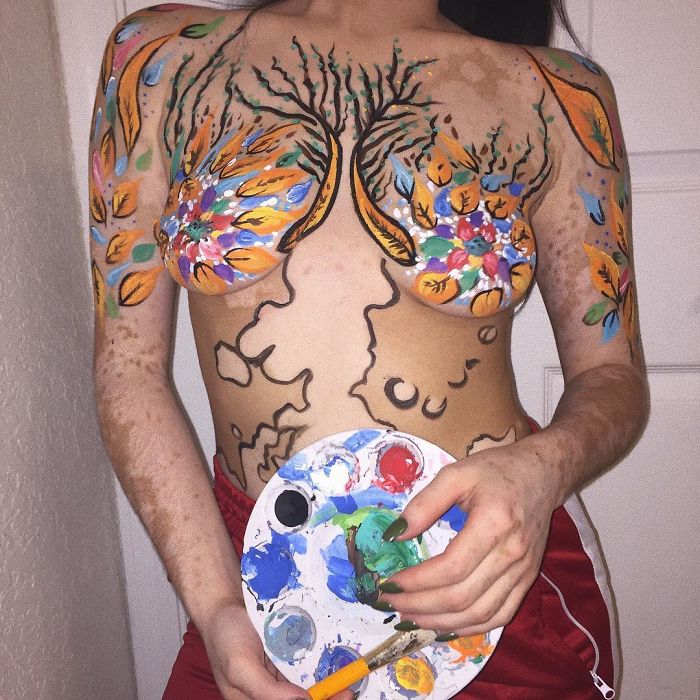 Vitiligo Ash Soto 9