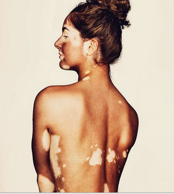 Retrato fotográfico de persona que padecen vitiligo, Brock Elbank