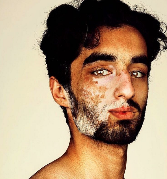 Retrato fotográfico de persona que padecen vitiligo, Brock Elbank