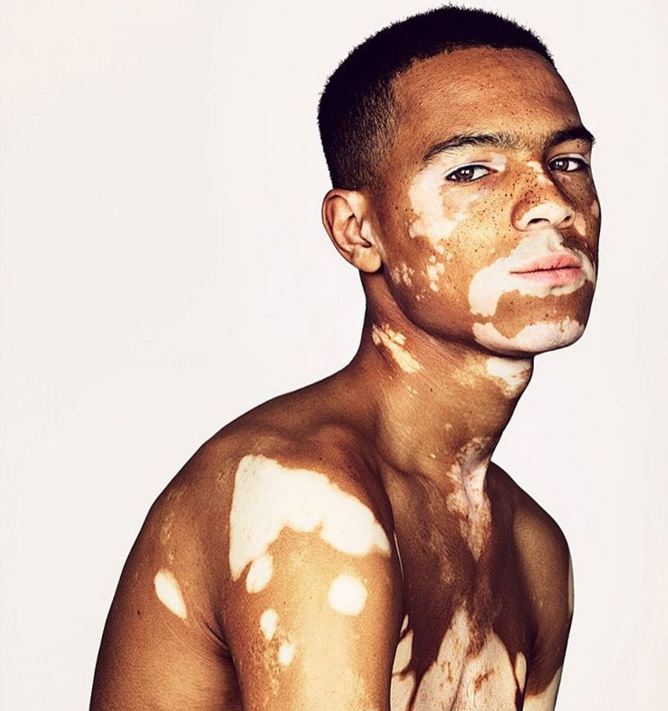 Retrato fotográfico de persona que padecen vitiligo, Brock Elbank