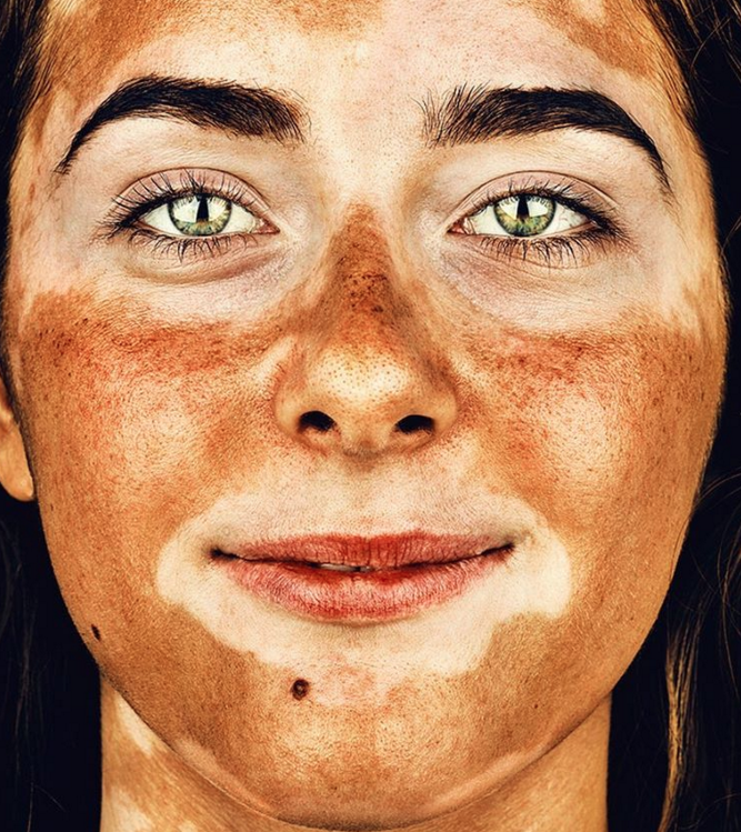Retrato fotográfico de persona que padecen vitiligo, Brock Elbank