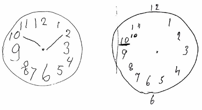 Tu forma de dibujar un reloj permite saber si sufrirás Alzheimer o  Parkinson