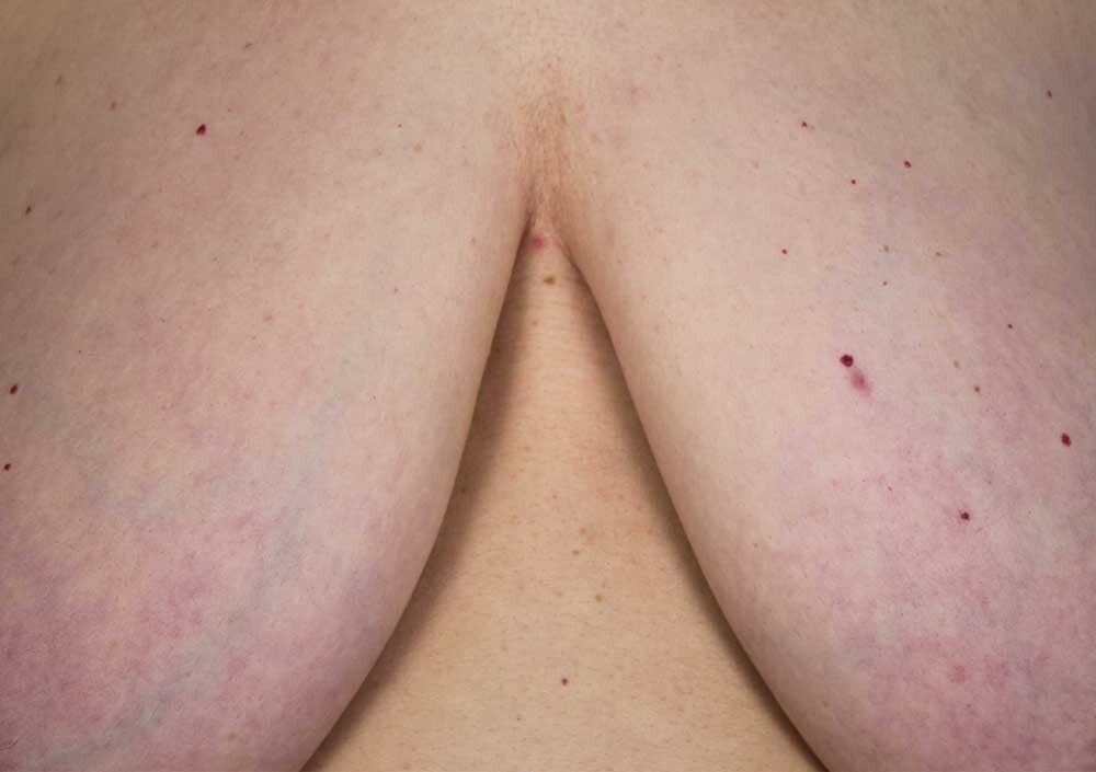 Berta García-Lacht, proyecto tetas