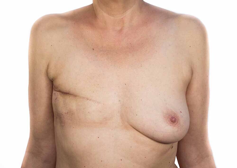 Berta García-Lacht, proyecto tetas