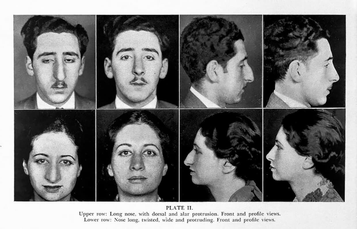 rinoplastia cirugia estetica belleza salud mental sociedad 2